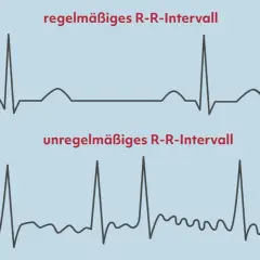 Oben: Regelmäßiges R-R-Intervall. Unten: Unregelmäßiges R-R-Intervall, ein mögliches Anzeichen für Herzkammerflimmern.