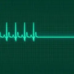 EKG-Linie auf grünem Hintergrund. Ein plötzlicher Herzstillstand, der auf eine mögliche Ursache für Kammerflimmern hinweist, wird durch eine gerade Linie dargestellt.