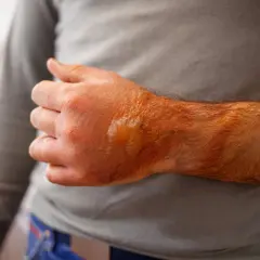 Schwere Verbrennungen 3. Grades an Hand und Unterarm, mit Blasenbildung und Rötung.
