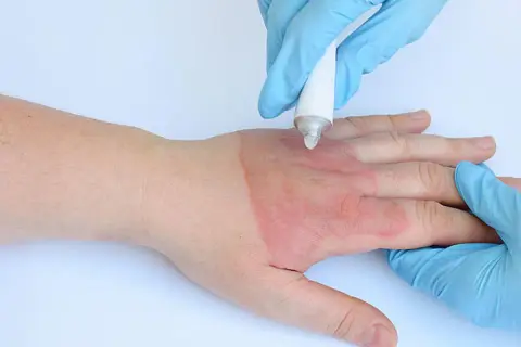Behandlung einer Verbrennung 1. Grades am Handrücken. Die Heilung dauert meist 1-2 Wochen.