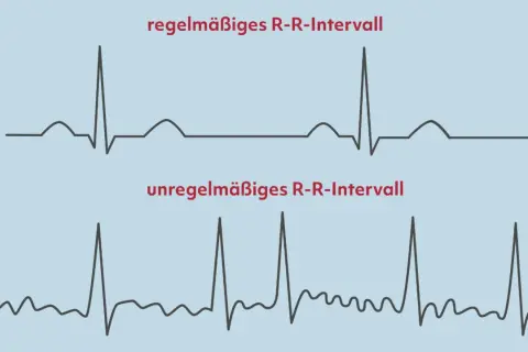 Oben: Regelmäßiges R-R-Intervall. Unten: Unregelmäßiges R-R-Intervall, ein mögliches Anzeichen für Herzkammerflimmern.