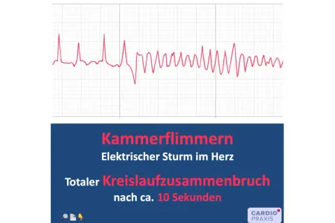 EKG-Kurve zeigt Kammerflimmern, einen elektrischen Sturm im Herz, der zu totalem Kreislaufzusammenbruch führt. Defibrillation ist hier lebensrettend.
