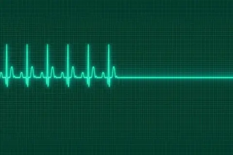 EKG-Linie auf grünem Hintergrund. Ein plötzlicher Herzstillstand, der auf eine mögliche Ursache für Kammerflimmern hinweist, wird durch eine gerade Linie dargestellt.