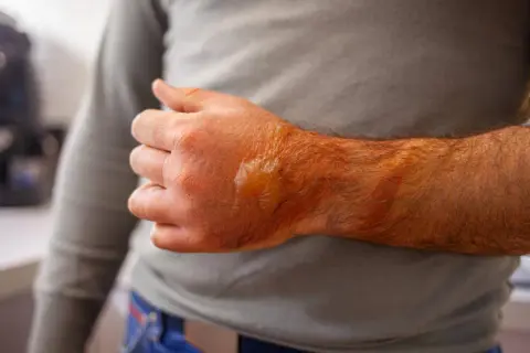 Schwere Verbrennungen 3. Grades an Hand und Unterarm, mit Blasenbildung und Rötung.