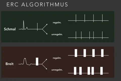 ERC Algorithmus: Schmale und breite QRS-Komplexe, die zu regelmäßigen oder unregelmäßigen Rhythmen führen. Diese Unterscheidung ist wichtig für die Behandlung von nicht defibrillierbare Rhythmen.