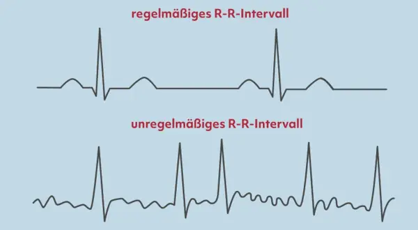 Oben: Regelmäßiges R-R-Intervall. Unten: Unregelmäßiges R-R-Intervall, ein mögliches Anzeichen für Herzkammerflimmern.