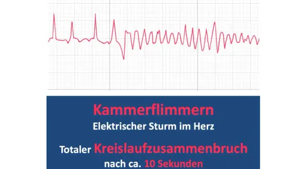 EKG-Kurve zeigt Kammerflimmern, einen elektrischen Sturm im Herz, der zu totalem Kreislaufzusammenbruch führt. Defibrillation ist hier lebensrettend.