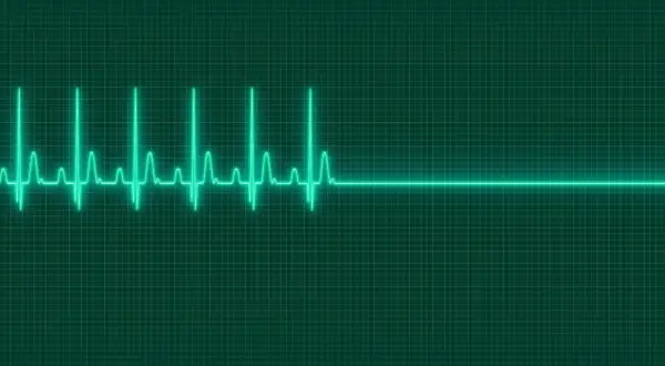 EKG-Linie auf grünem Hintergrund. Ein plötzlicher Herzstillstand, der auf eine mögliche Ursache für Kammerflimmern hinweist, wird durch eine gerade Linie dargestellt.