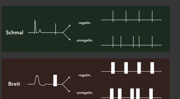 ERC Algorithmus: Schmale und breite QRS-Komplexe, die zu regelmäßigen oder unregelmäßigen Rhythmen führen. Diese Unterscheidung ist wichtig für die Behandlung von nicht defibrillierbare Rhythmen.