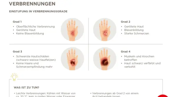 Verbrühungen werden nach ihrem **Verbrennung grad** eingestuft: Grad 1 (gerötete Haut), Grad 2 (Blasenbildung), Grad 3 (Hautfetzen) und Grad 4 (verkohlte Haut).