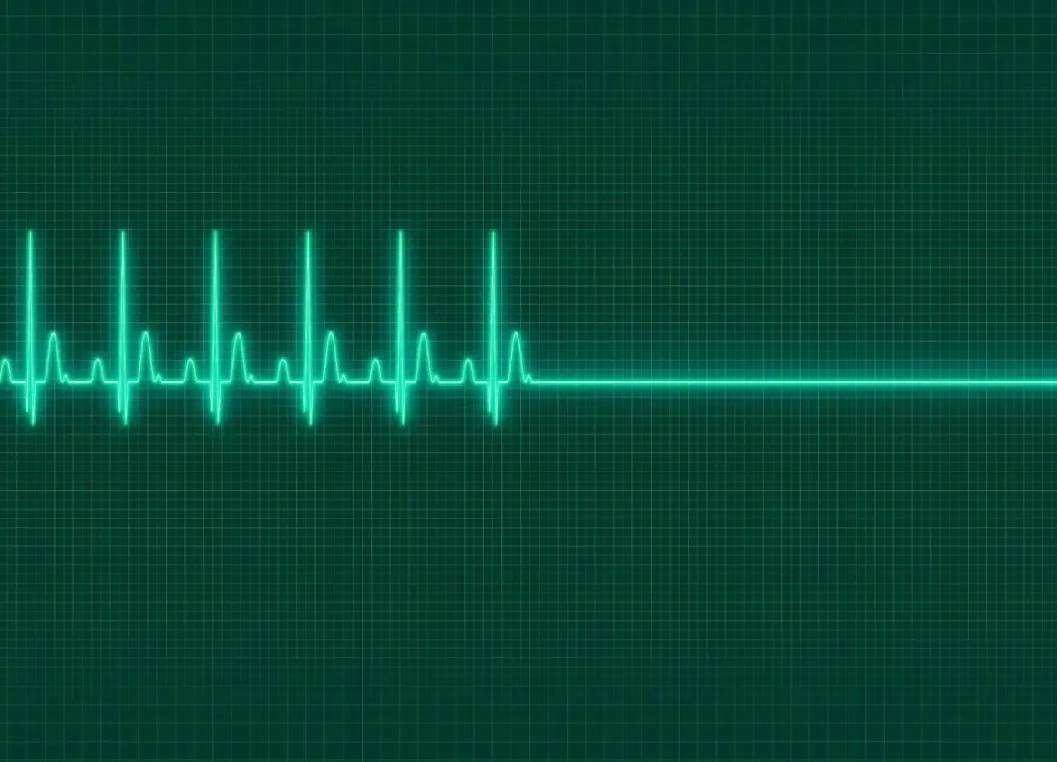 EKG-Linie auf grünem Hintergrund. Ein plötzlicher Herzstillstand, der auf eine mögliche Ursache für Kammerflimmern hinweist, wird durch eine gerade Linie dargestellt.