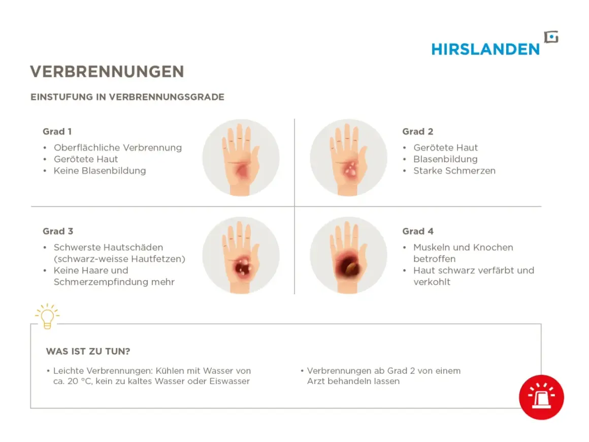 Verbrühungen werden nach ihrem **Verbrennung grad** eingestuft: Grad 1 (gerötete Haut), Grad 2 (Blasenbildung), Grad 3 (Hautfetzen) und Grad 4 (verkohlte Haut).