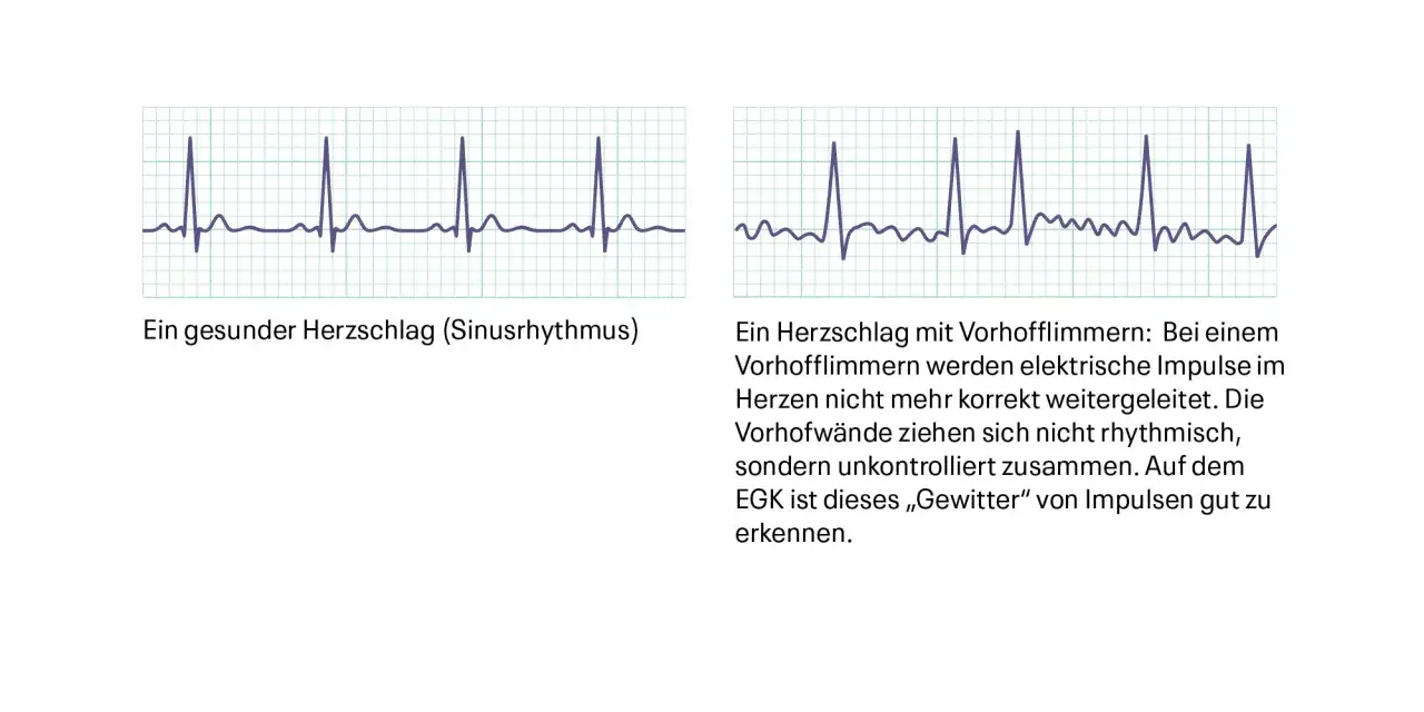 Vergleich von EKG-Kurven: gesunder Sinusrhythmus vs. Vorhofflimmern, ein Beispiel für nicht defibrillierbare Rhythmen.
