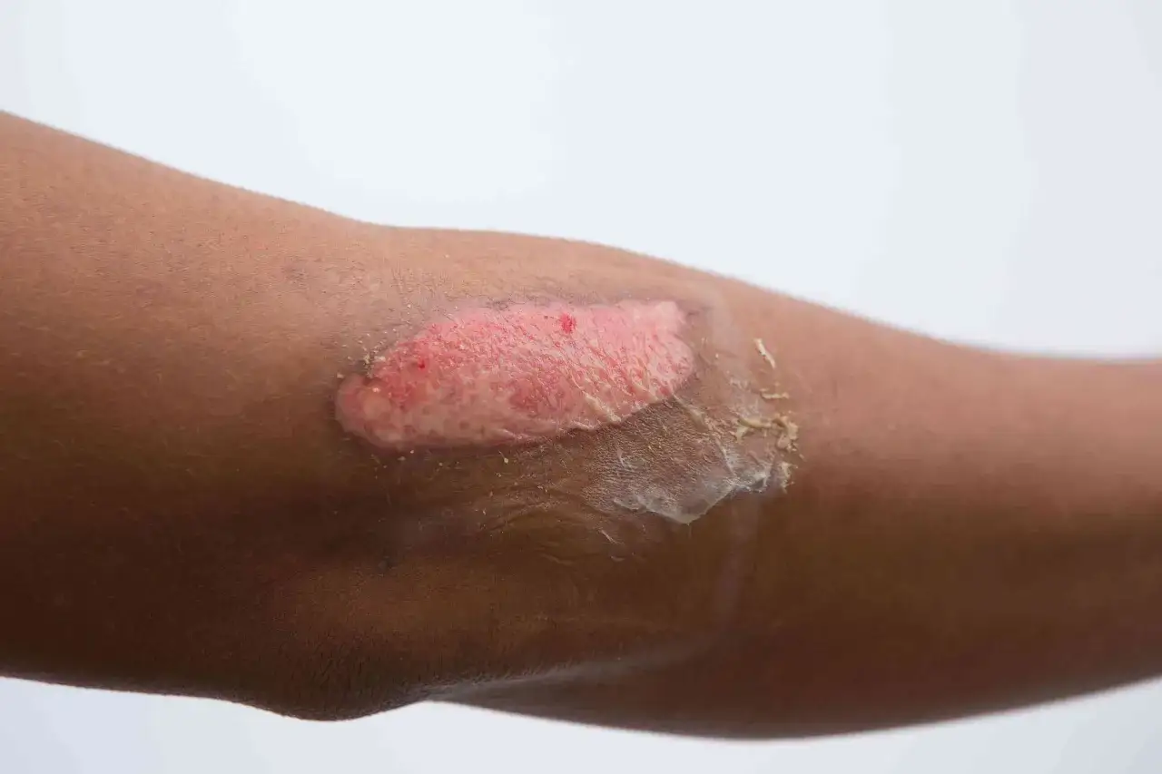 Arm mit einer Verbrennung 1. Grades. Die Heilung dauert meist 1-2 Wochen.