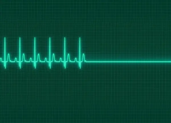 EKG-Linie auf grünem Hintergrund. Ein plötzlicher Herzstillstand, der auf eine mögliche Ursache für Kammerflimmern hinweist, wird durch eine gerade Linie dargestellt.